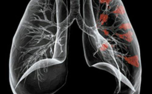 ֧���ܷ��׵�֢״ ֧���ܷ�����μ���